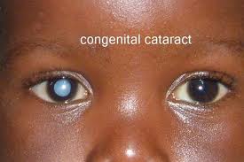 Pediatric_Ophthalmology_clip_image004 Pediatric_Ophthalmology_clip_image004