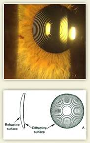 Refractive_Surgery_clip_image007