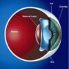 ICL surgery cost jalandhar punjab ICL surgery at Harpreet Eye and Dental Care Centre jalandhar punjab