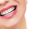 dental wiring braces treatment cost jalandhar punjab india dental wiring braces treatment cost at Harpreet Eye and Dental Care Centre Jalandharjalandhar punjab india