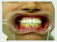 bridge-after bridge-after