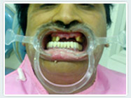 bridge-before bridge-before