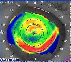 blade less lasik laser price jalndhar punjab india