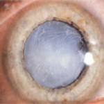 stichless phaco cataract surgery jalandhar punjab india