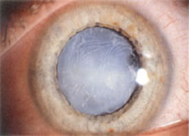 stichless phaco cataract surgery jalandhar punjab india