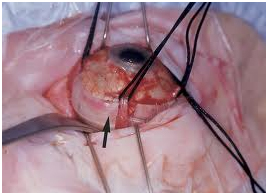 contact_lenses_and_spectacles_clip_image008