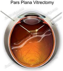 contact_lenses_and_spectacles_clip_image012