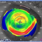 lasik laser eye surgery jalandhar topography