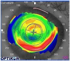 lasik laser eye surgery jalandhar topography