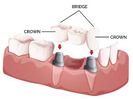 dental bridges dentist jalandhar punjab india dental bridges dentist jalandhar punjab india