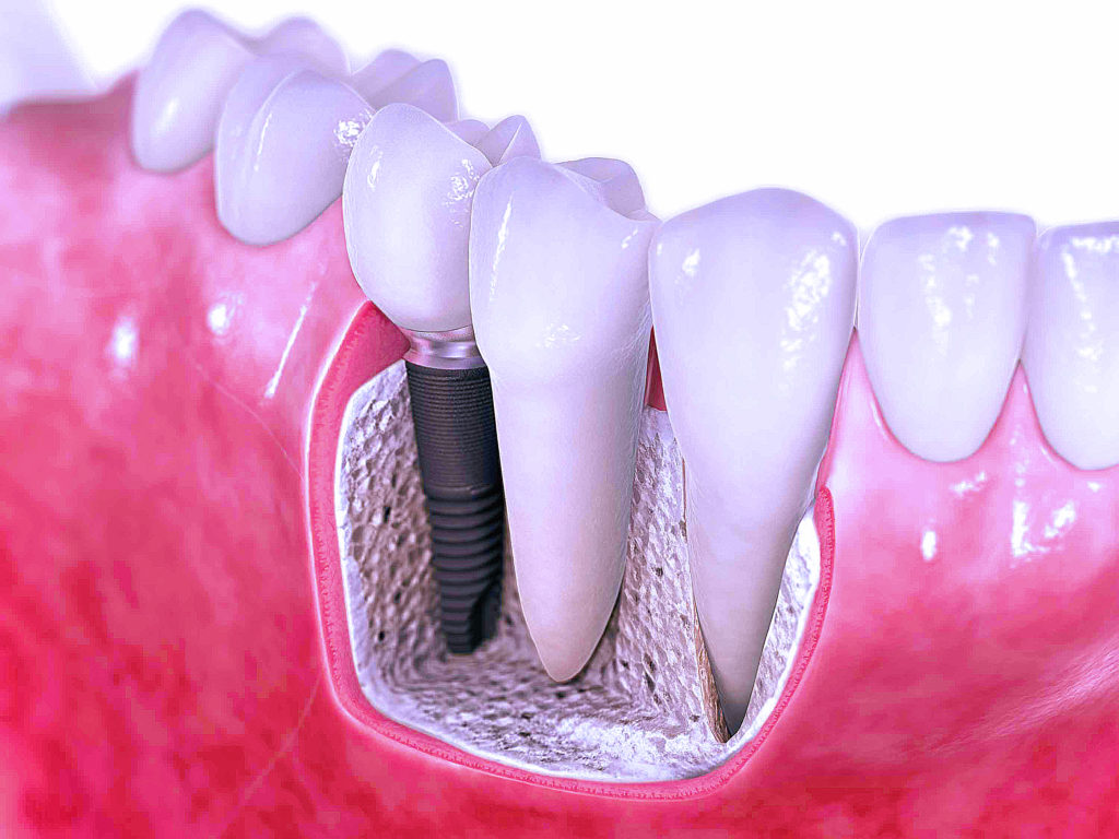 dental implant in just 3 days jalandhar punjab india dental implant in just 3 days jalandhar punjab india