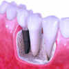 dental implant in just 3 days at Harpreet Eye and Dental Care Centre jalandhar punjab india dental implant in just 3 days at Harpreet Eye and Dental Care Centre jalandhar punjab india