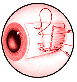 squint treatment price jalandhar punjab india