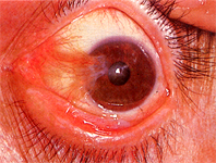 pterygium nakhuna operation jalandhar punjab