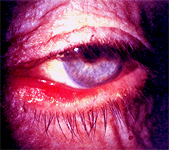 ectropion operation jalandhar punjab