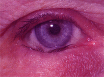 entropion operation jalandhar punjab