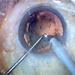 stichless phaco cataract surgery jalandhar punjab india