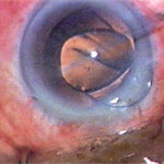 stichless phaco cataract surgery jalandhar punjab india