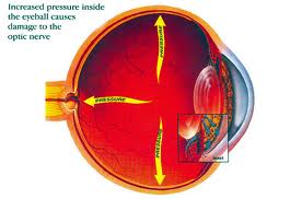 glaucoma surgery jalandhar punjab india glaucoma surgery jalandhar punjab india
