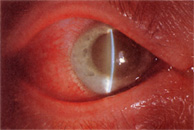 glaucoma surgery jalandhar punjab india glaucoma surgery jalandhar punjab india