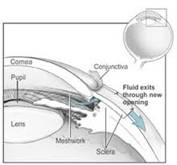glaucoma kalamotia treatment jalandhar punjab india glaucoma kalamotia treatment jalandhar punjab india