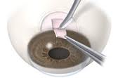glaucoma kalamotia surgery price jalandhar punjab india glaucoma kalamotia surgery price jalandhar punjab india