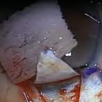 glaucoma kalamotia surgery cost jalandhar punjab india glaucoma kalamotia surgery cost jalandhar punjab india