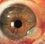 glaucoma kalamotia surgery cheap price jalandhar punjab india