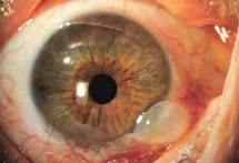 glaucoma kalamotia surgery cheap price jalandhar punjab india glaucoma kalamotia surgery cheap price jalandhar punjab india