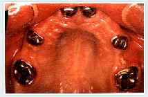 missing-teeth missing-teeth