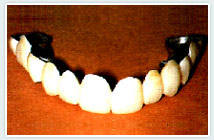 missing-teeth2 missing-teeth2