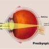 RLE surgery with Ringless Multifocal lens at Harpreet Eye and Dental Care Centre jalandhar punjab india RLE surgery with Ringless Multifocal lens at Harpreet Eye and Dental Care Centre jalandhar punjab india