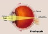 presbyopia
