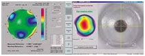 wavefront lasik laser surgery