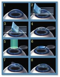 lasik eye surgery steps