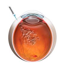 intravitreal injection avastin jalandhar punjab