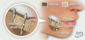 fixed teeth in 3 days basal implants jalandhar punjab india
