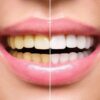 cost of dental bleaching in jalandhar punjab cost of dental bleaching in jalandhar punjab