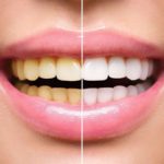 cost of dental bleaching in jalandhar punjab