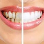 tooth whitening cost at Harpreet Eye and Dental Care Centre Jalandharjalandhar punjab india