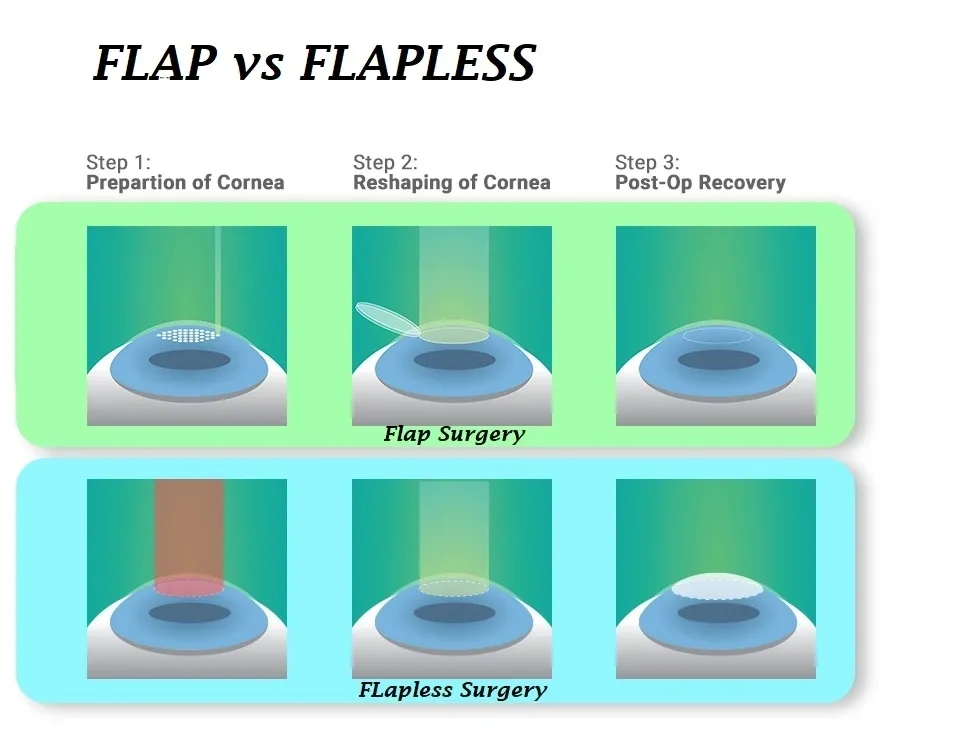 silk laser flapless laser