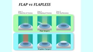 best lasik laser surgery jalandhar punjab