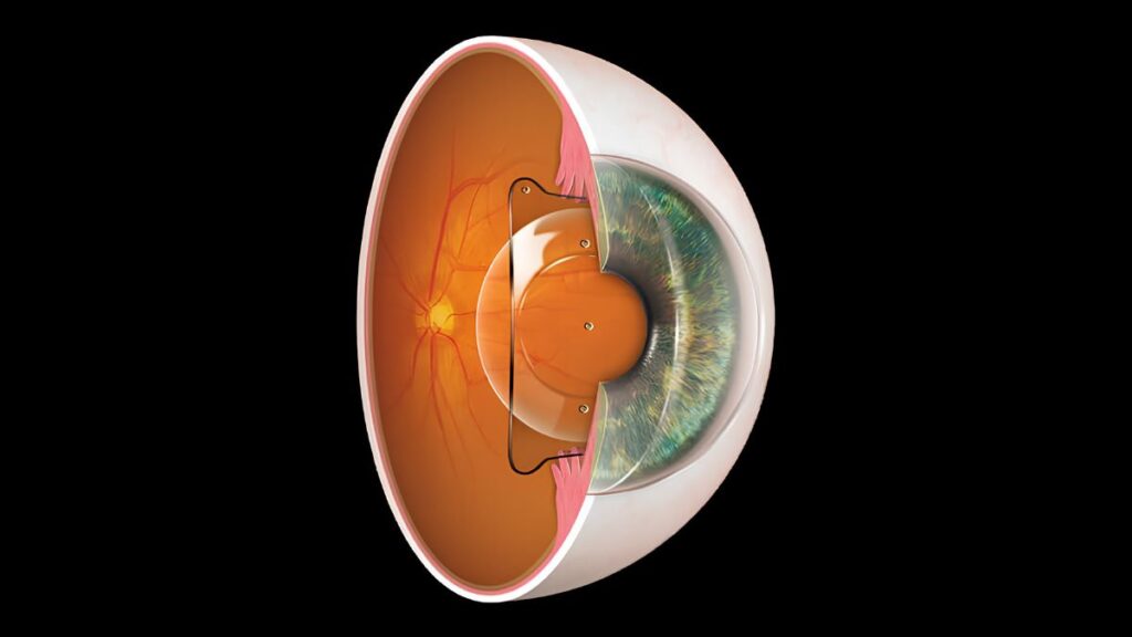ICL surgery cost best eye hospital Jalandhar punjab