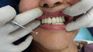 PRICE OF DENTAL IMPLANTS IN 3 DAYS PUNJAB