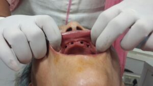 PRICE OF DENTAL IMPLANTS IN 3 DAYS PUNJAB