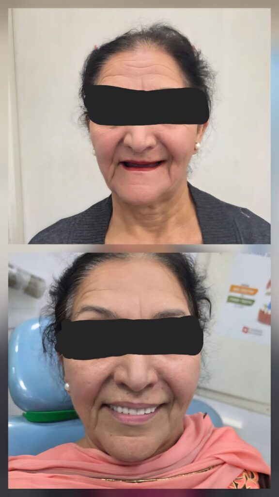Dental implant in 3 days punjab