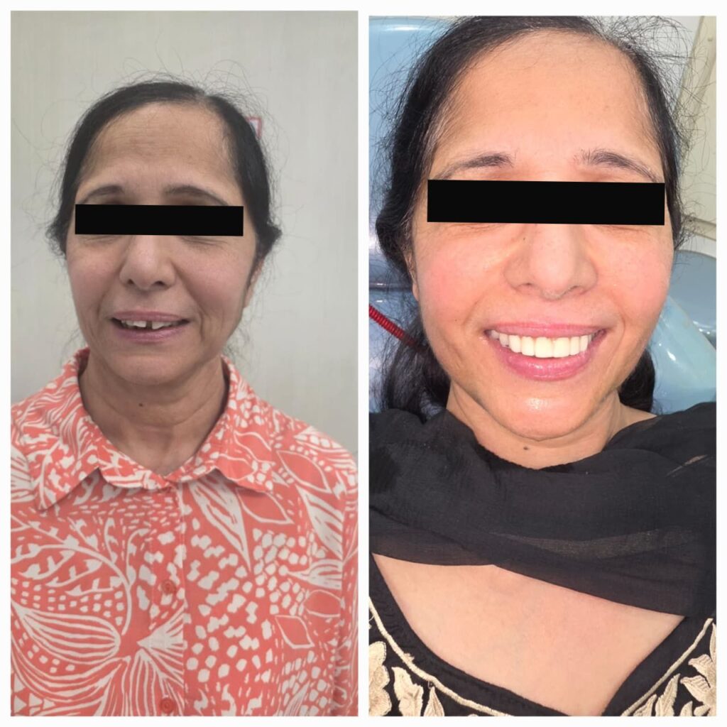 Dental implant in 3 days cost punjab