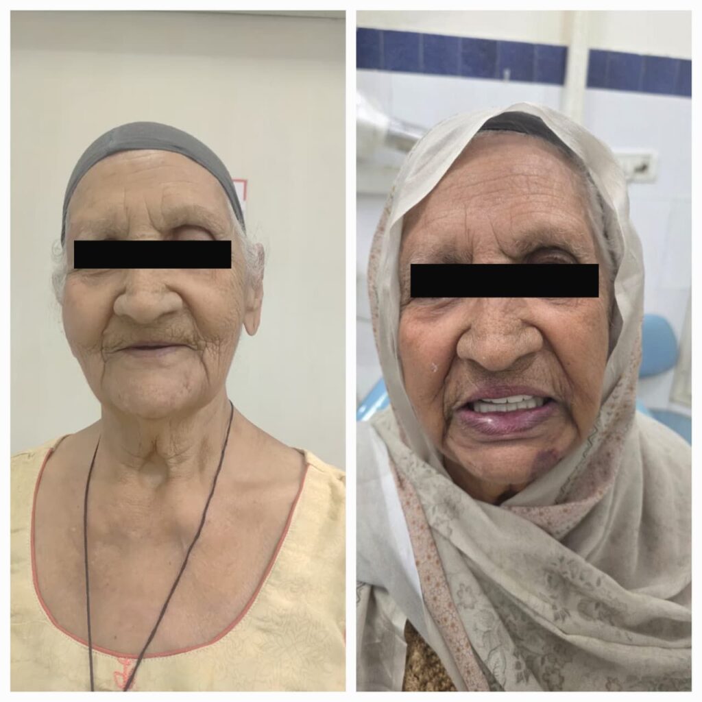 Dental implants in 3 days india