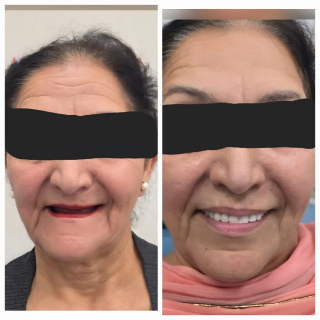 Fast dental implant in 3 days punjab Fast dental implant in 3 days punjab