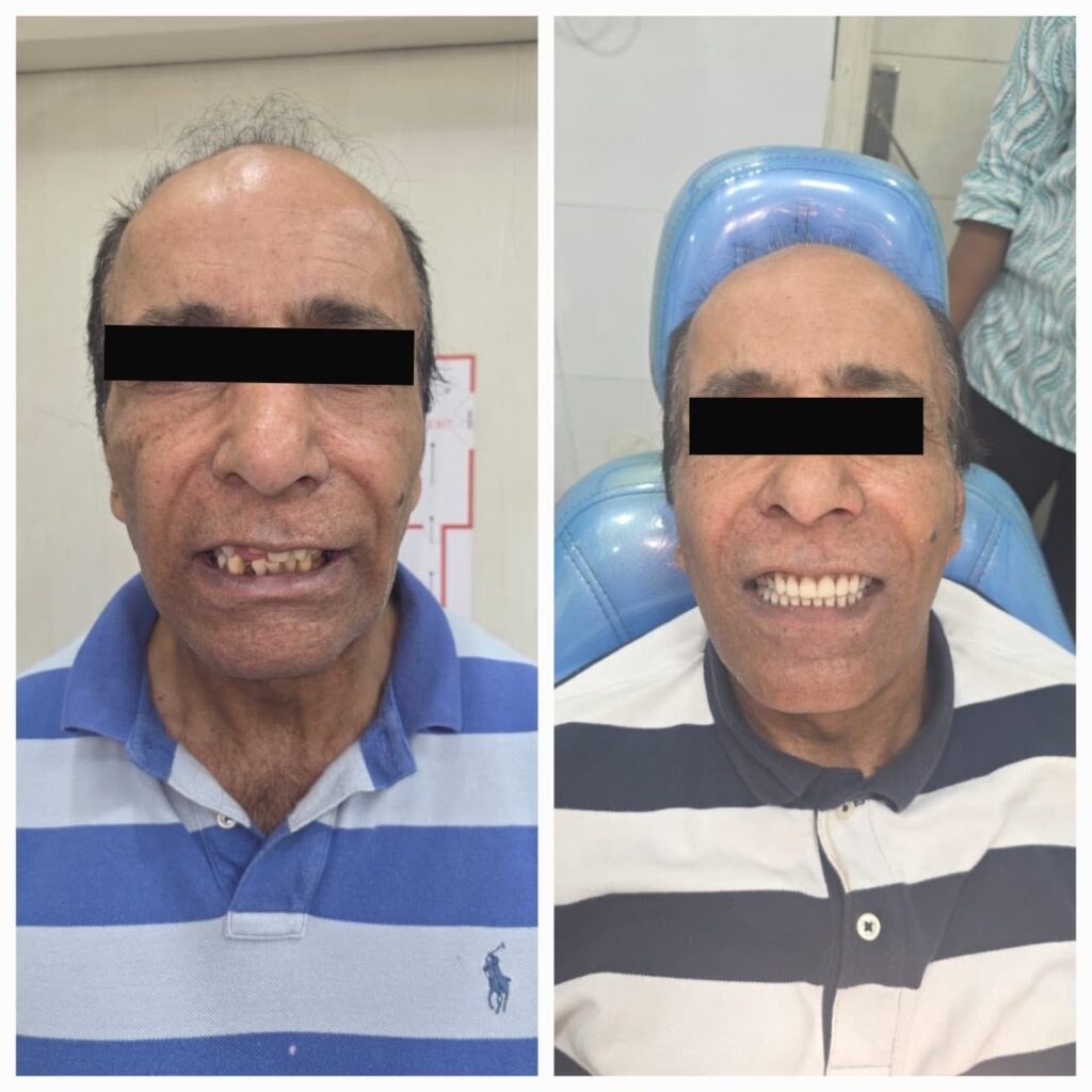 dental implant in 3 days price Jalandhar